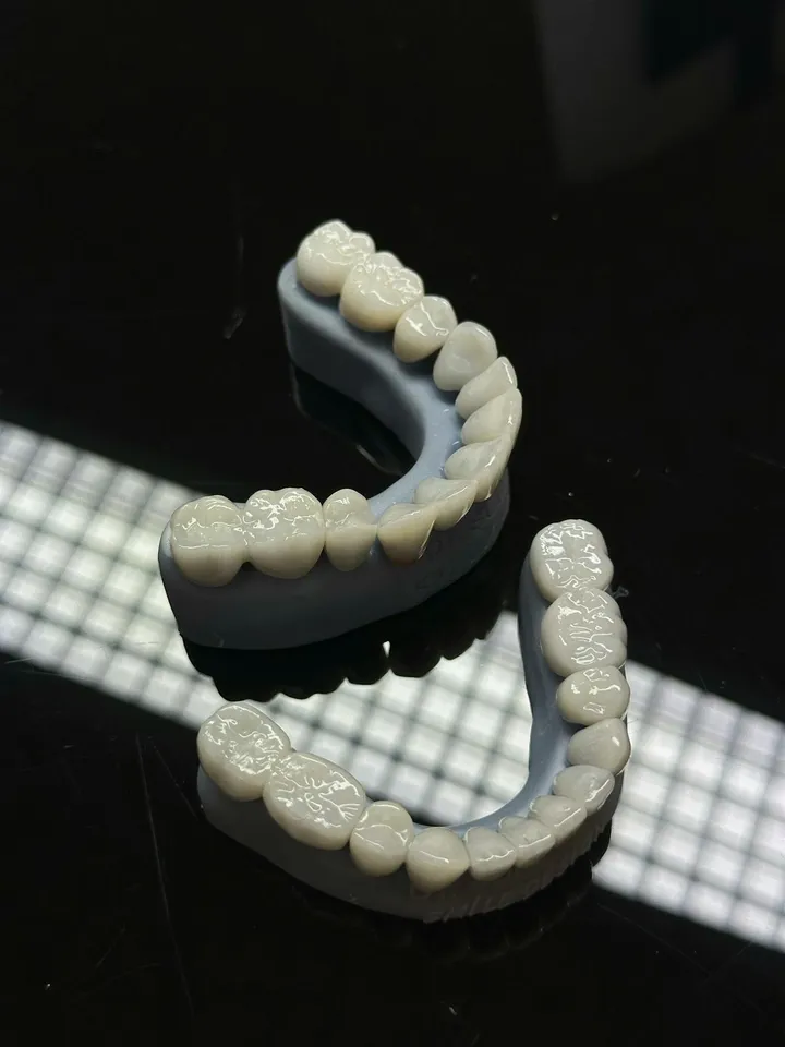 Custom porcelain veneer shells fabricated at a dental laboratory