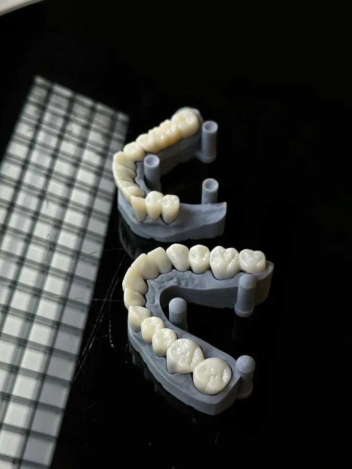 Zirconium crown treatment and dental laboratory planning